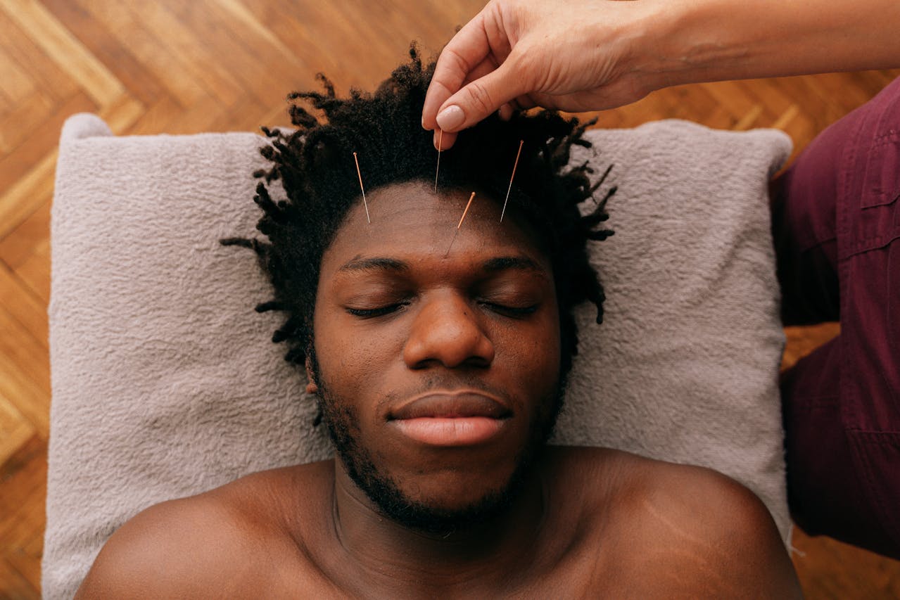 image-of-acupuncturist-putting-needles-on-the-forehead