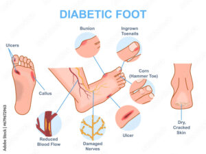 image-of-diabetic-foot-medical-diagram