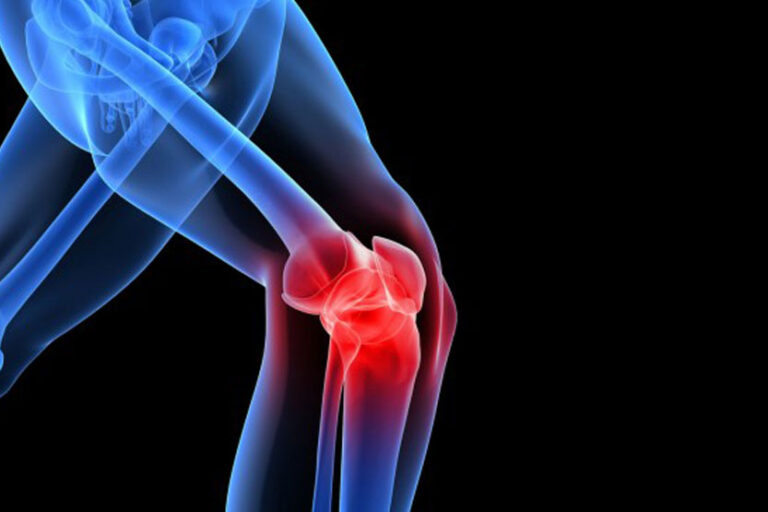 Understanding MCL Injuries: Causes & Care - Healthproof Physio